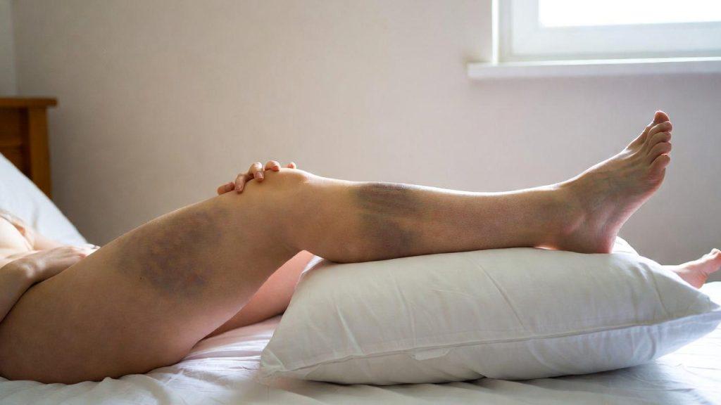 Ridicarea membrului afectat